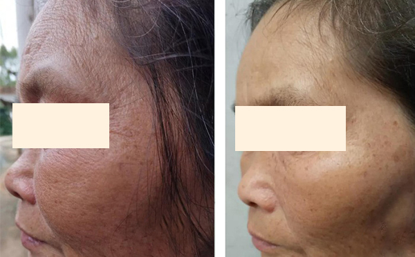 筋膜懸吊除皺效果怎么樣?需要多久恢復(fù)?