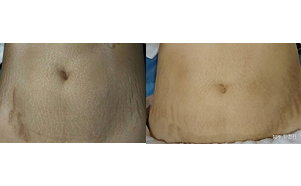 激光去妊娠紋有哪些優(yōu)勢？