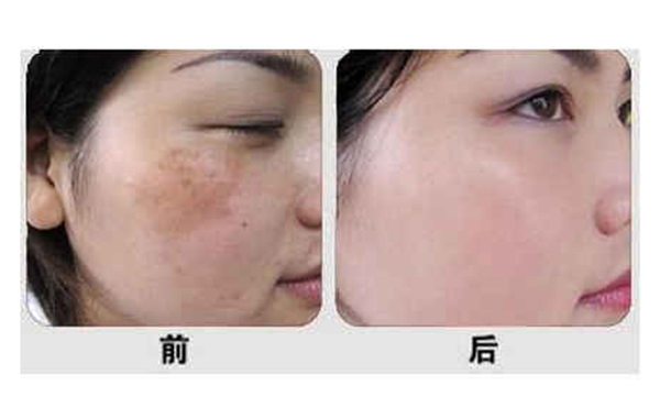 光子嫩膚有什么優(yōu)勢(shì)？