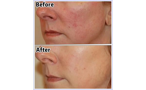 光子嫩膚會(huì)讓皮膚變薄嗎？