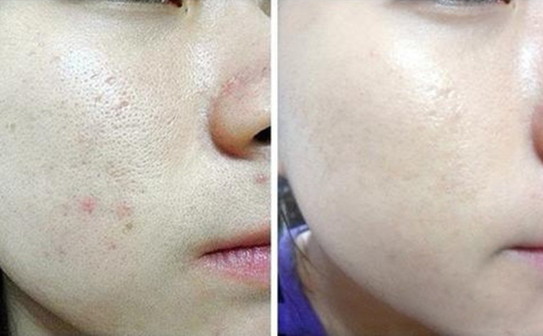 光子嫩膚的過程是什么？