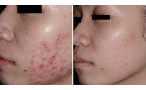 果酸煥膚好不好？