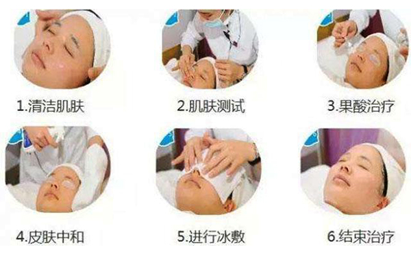 果酸煥膚的過程是什么？