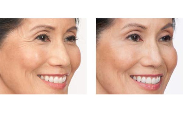 水光針適合哪個年齡段？