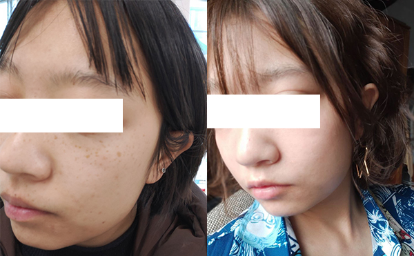 激光祛斑效果好不好？