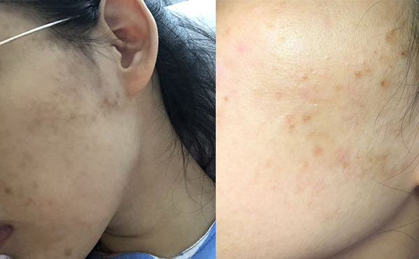 白瓷娃娃對黃皮有效嗎？