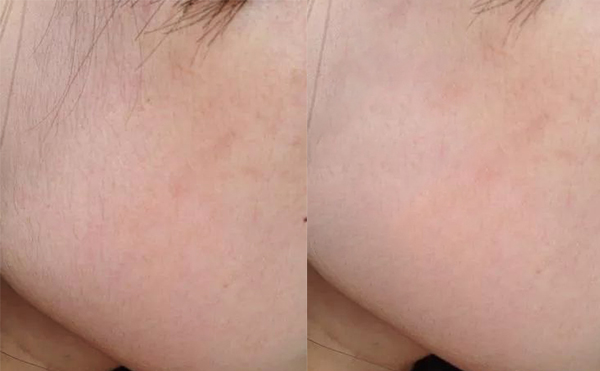 冰點(diǎn)面部脫毛的價(jià)格多少?費(fèi)用貴不貴?