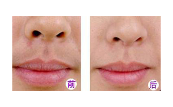 冰點脫毛好不好？