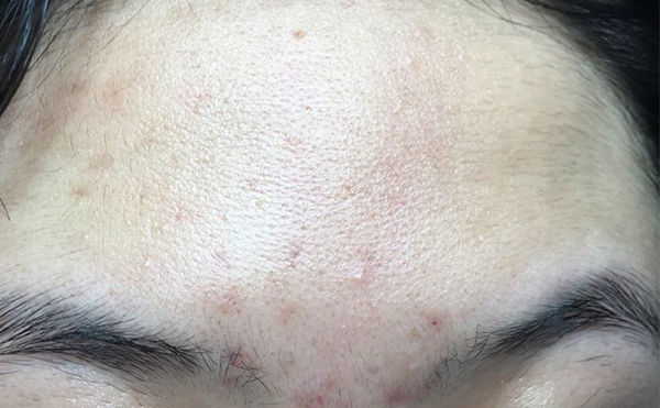 冰點脫毛有什么缺點嗎?