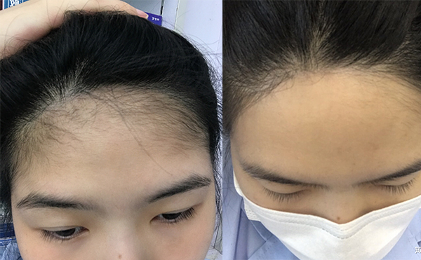 激光脫發(fā)際線的過(guò)程是什么？