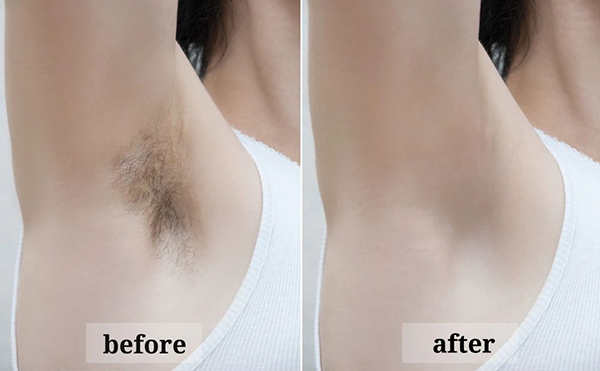 激光脫腋毛效果怎么樣？