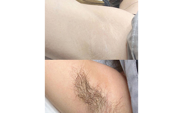 脫腋毛多少錢一次?價(jià)格很貴嗎?