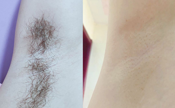 冰點脫腋毛要脫幾次？