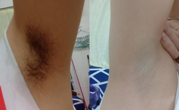 冰點脫腋毛過程是什么？