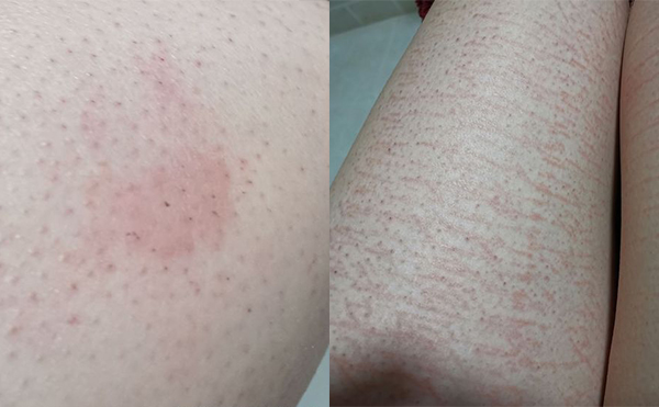 錯誤脫毛有什么后果？