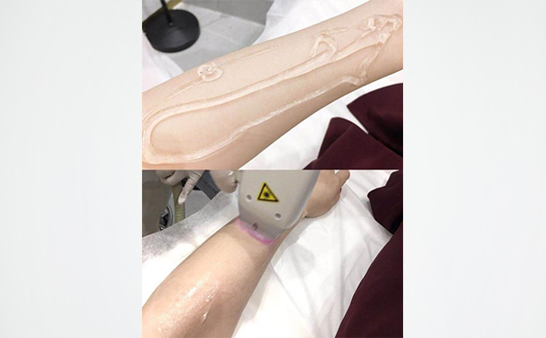 激光手臂脫毛是怎么做的？