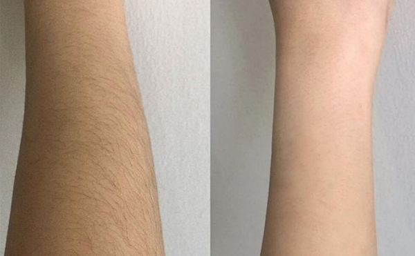 脫毛會(huì)影響新陳代謝嗎？