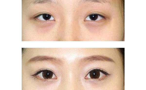 眼綜合和隆鼻可以一起做嗎？