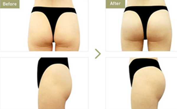 豐臀和提臀有什么區(qū)別?提臀有什么風險?