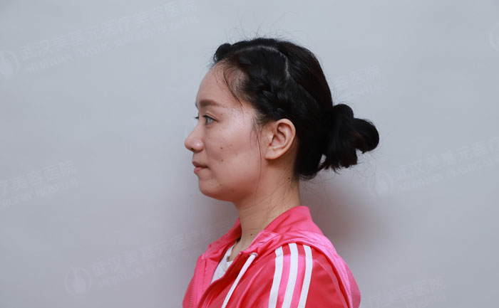 顴骨突出怎樣改善？