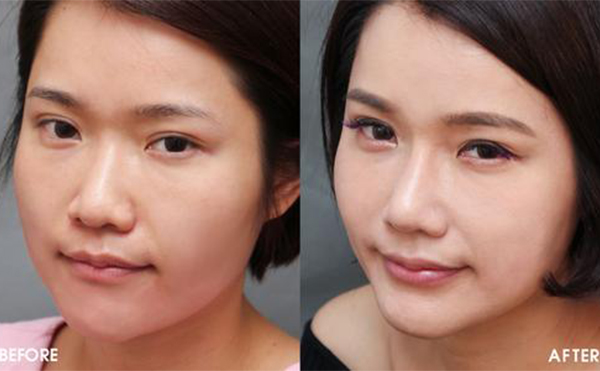 隆鼻手術怎么做效果會很好？