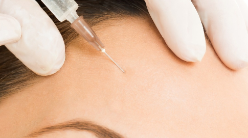 玻尿酸豐額頭怎么樣？