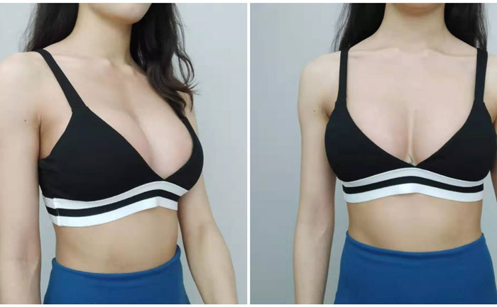 隆胸失敗多久可以做修復(fù)手術(shù)？隆胸手術(shù)失敗修復(fù)多少錢