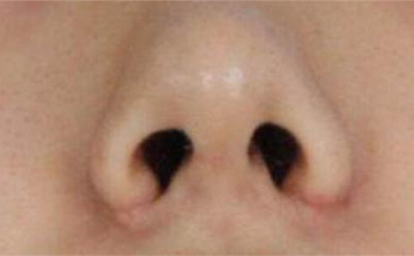 鼻翼缺損矯正手術(shù)方法