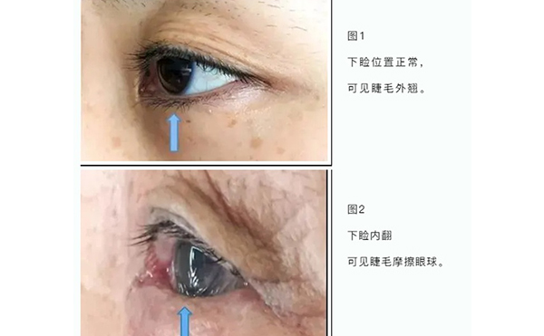 老年人眼瞼內(nèi)翻原因有哪些?老年人眼瞼內(nèi)翻怎樣治療?