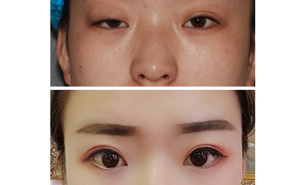 大小眼矯正多少錢?術后效果好不好?