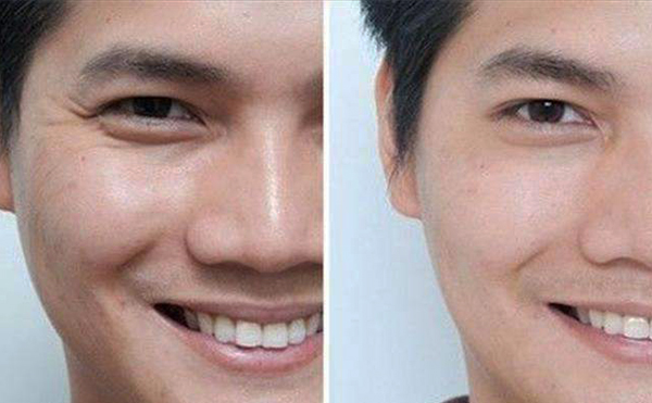 玻尿酸眼部除皺效果怎么樣？