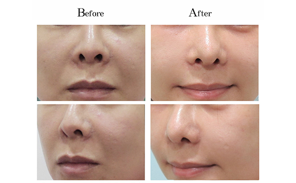 玻尿酸去法令紋有什么優(yōu)勢(shì)？