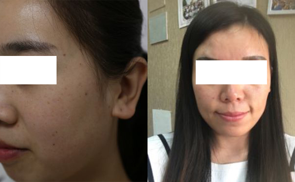 激光和光子嫩膚哪個祛斑效果好？怎么選擇？