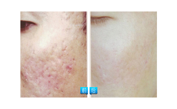 果酸煥膚多少錢？