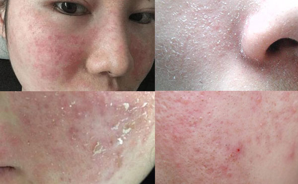 e光嫩膚有什么風(fēng)險？