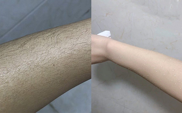 冰點(diǎn)手臂脫毛