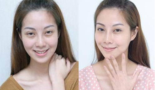 熱瑪吉手術效果