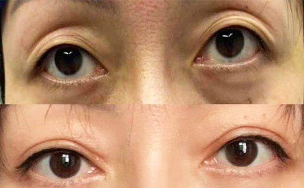 眼瞼凹陷術(shù)后有什么并發(fā)癥?有什么注意事項(xiàng)?