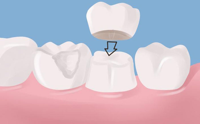 牙冠修復(fù)后能堅持幾年？