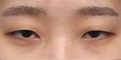 內(nèi)眥贅皮矯正術(shù)前