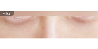 微針去黑眼圈術(shù)后