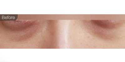 微針去黑眼圈術(shù)前