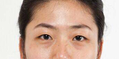 光纖溶脂祛眼袋術(shù)前