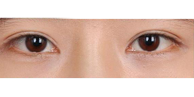 埋線雙眼皮術(shù)后