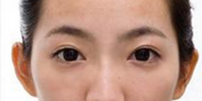 激光去黑眼圈術后