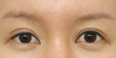 開外眼角術(shù)前