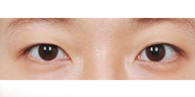 定點(diǎn)雙眼皮術(shù)前