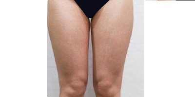 隔空溶脂瘦大腿術(shù)前