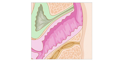 激光緊縮陰道術前