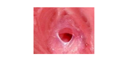 處女膜修復術(shù)后